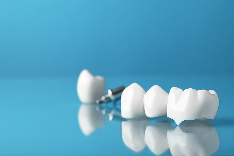 The Different Types of Dental Crowns