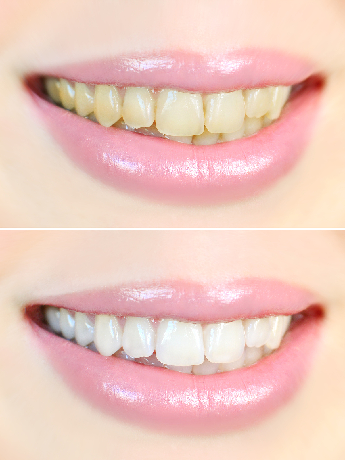 Get Natural White Smile with Professional Teeth Whitening