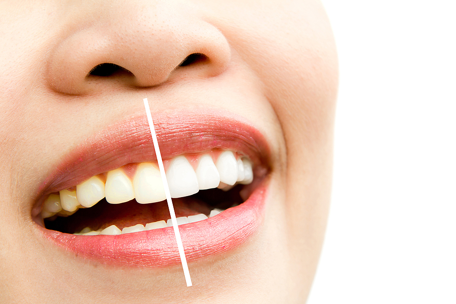 Brighten Your Smile with a Professional Teeth Whitening Service in Hanahan, SC